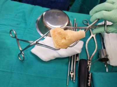 El Hospital Doctor Jos&eacute; Molina Orosa realiza la primera cirug&iacute;a con injerto de hueso