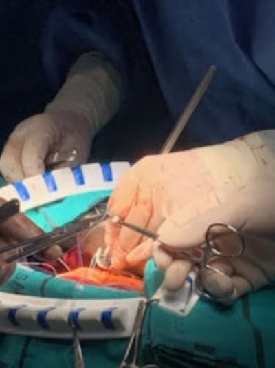 En el HUC Intervenci&oacute;n quirurgica cardiaca exitosa, de reparaci&oacute;n de v&aacute;lvula a&oacute;rtica implantando Anillo HAART