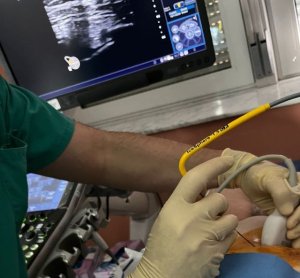 El Hospital La Candelaria incorpora la técnica de la crioablación para el tratamiento del cáncer de mama