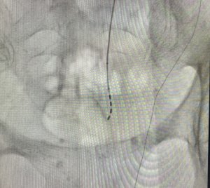 El Molina Orosa incorpora la neuromodulación de raíces sacras para el tratamiento de la incontinencia