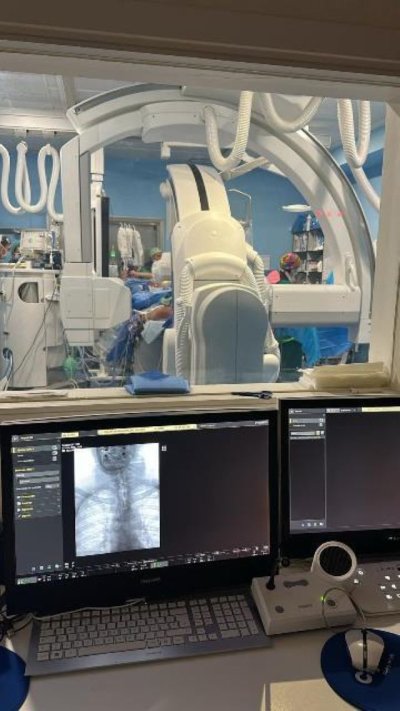 El Hospital Doctor Negrín pone en marcha la trombectomía mecánica para el tratamiento de ictus isquémicos graves