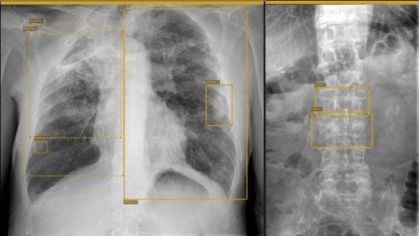 El Hospital La Candelaria pone en marcha un proyecto piloto de inteligencia artificial aplicado a radiodiagnóstico