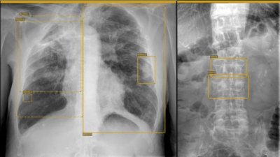 El Hospital La Candelaria pone en marcha un proyecto piloto de inteligencia artificial aplicado a radiodiagn&oacute;stico