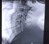El Hospital de La Palma incorpora una t&eacute;cnica pionera en Canarias en el tratamiento de hernias cervicales